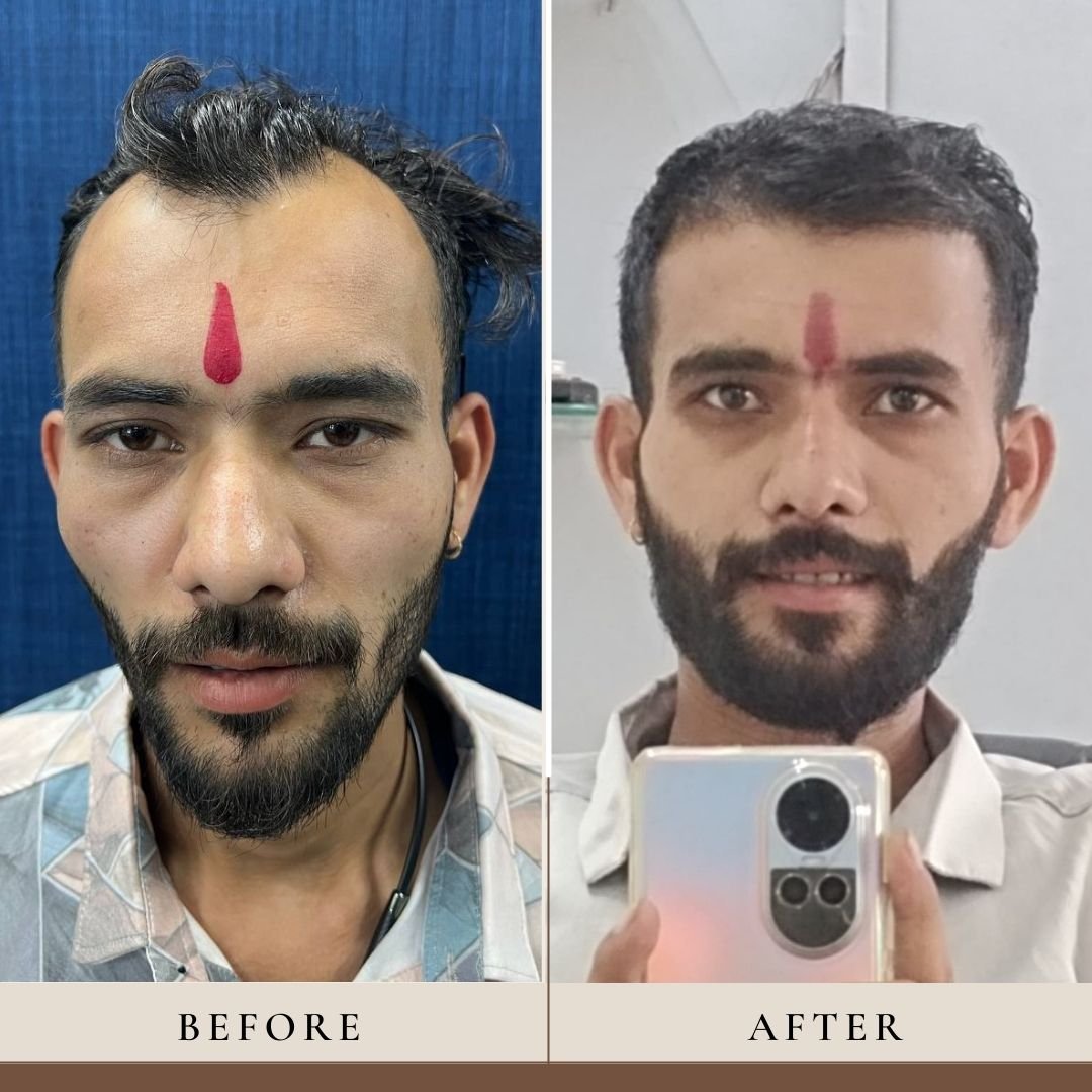 Hair Transplant Result